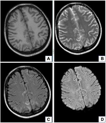 Advances in imaging findings of preeclampsia-related reversible posterior leukoencephalopathy syndrome